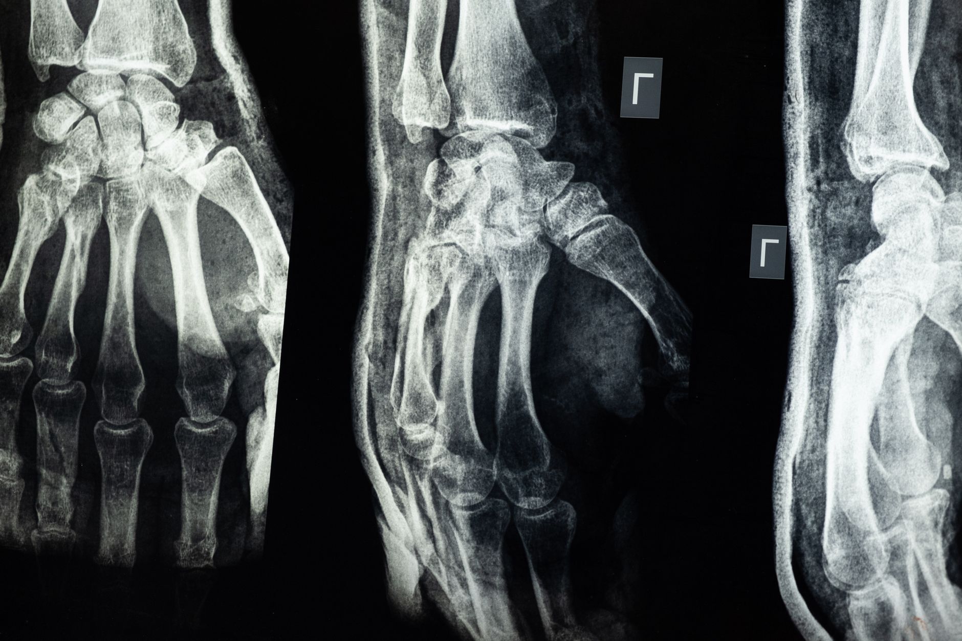 X-ray phát hiện được tạp chất phi kim loại không?